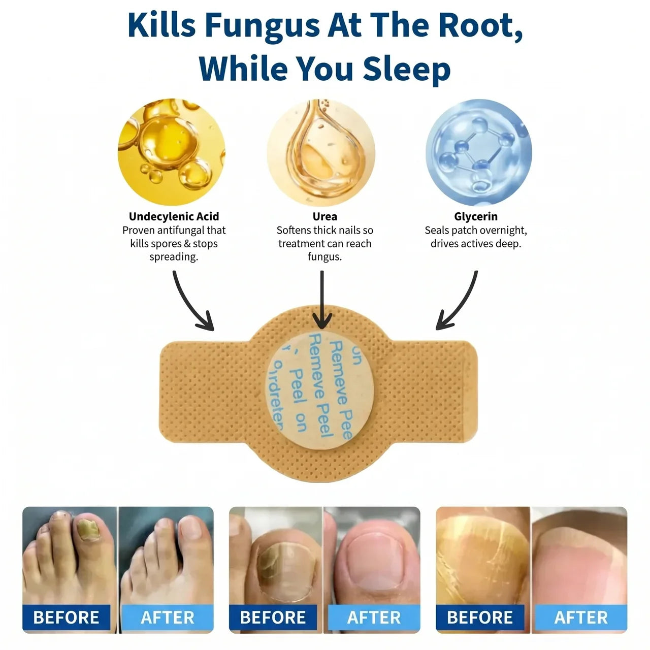 NORVIA™ Fungal Nail Patches